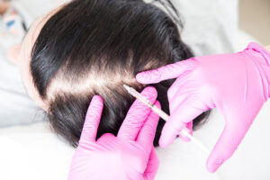 Women's Hair Loss: Understanding the Causes and Exploring Solutions PRP (Platelet-Rich Plasma) therapy for hair loss treatment in women